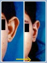 Ear resocnstruction for prominent ear