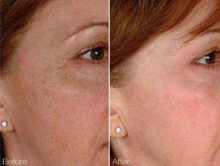 laser tightening pores skin wrinkles ipl genesis fine co2 above removal titan xl