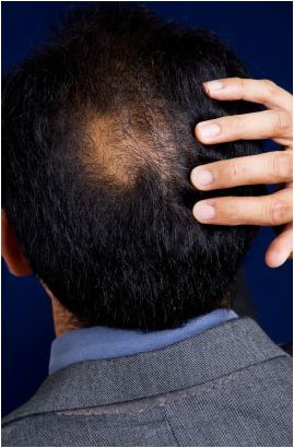balding