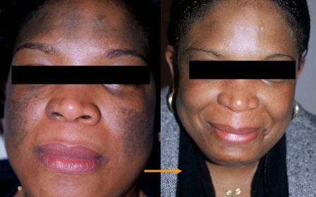 Removal of birthmark with Q-switch laser