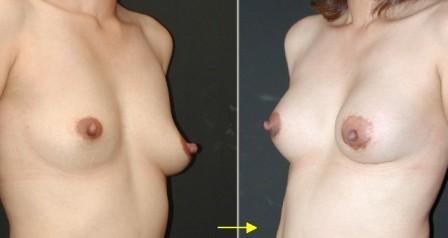 asymmetric breast with augmentation