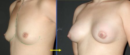 breast augmentation