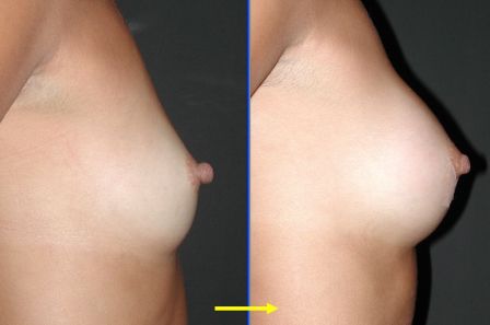 Breast augmentation