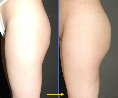 Buttock augmentation using fat tissue graft 