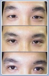 Result of DST double-eyelids technique