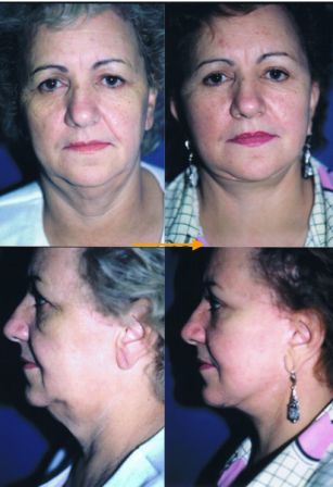 facelift
