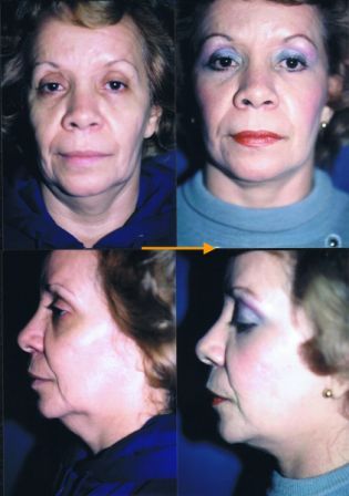 facelift