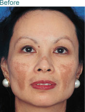 melasma