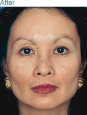 melasma