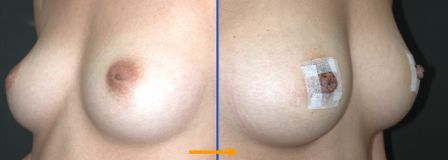 repair of retracted nipple