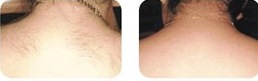 laser hair removal of upper back