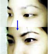 Asian double-eyelids